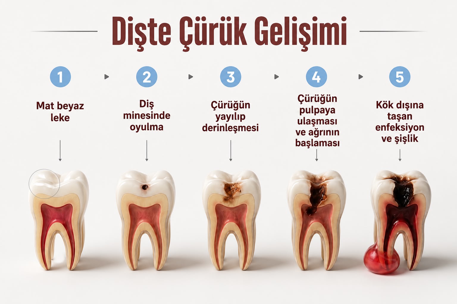 Diş Sağlığı — Diş Çürükleri